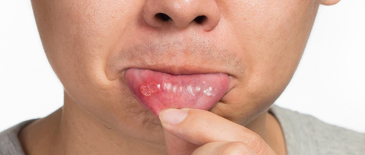 Dental Health Article by Dr Emma - "Ulcers" 