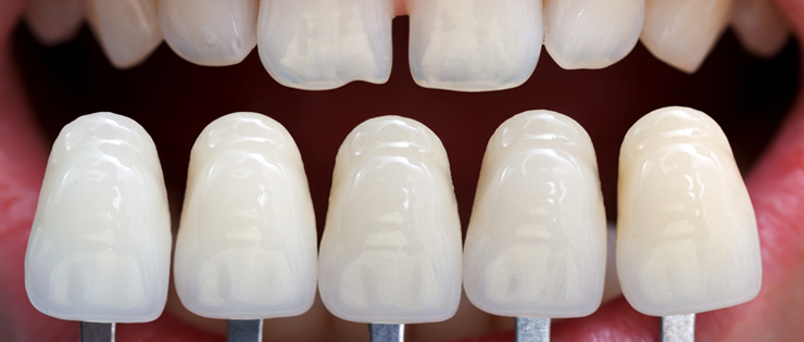 Dental Health Article by Dr Emma - "Failed Veneers" 