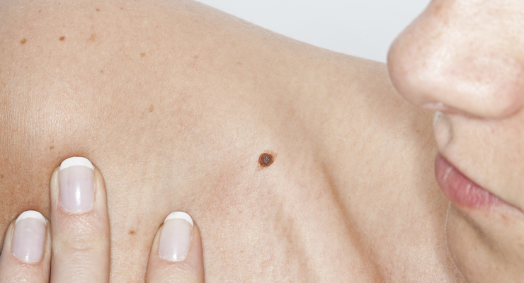 How To Check Your Moles For Signs Of Skin Cancer